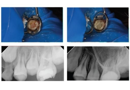 Maarc Ceraset MTA Putty (9971/0.7)