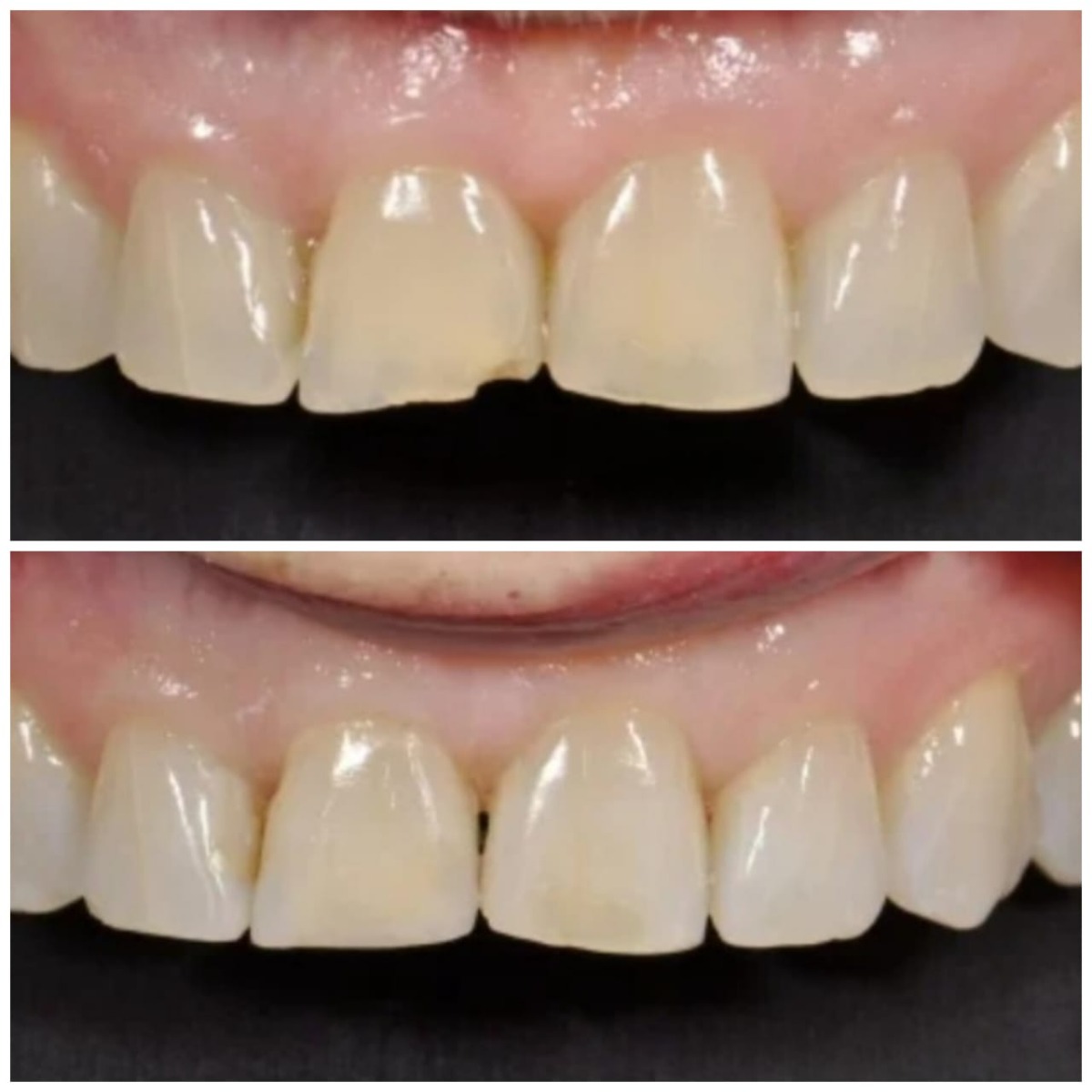 Xcem Merge GIC LC Compomer 