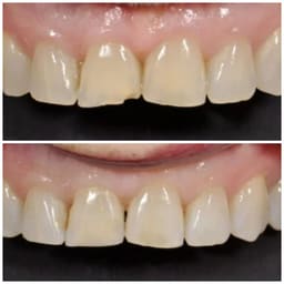 Xcem Merge GIC LC Compomer  - 6