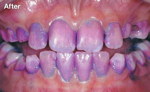 Dr Denti Disclosing Tablets (28 Tablets)