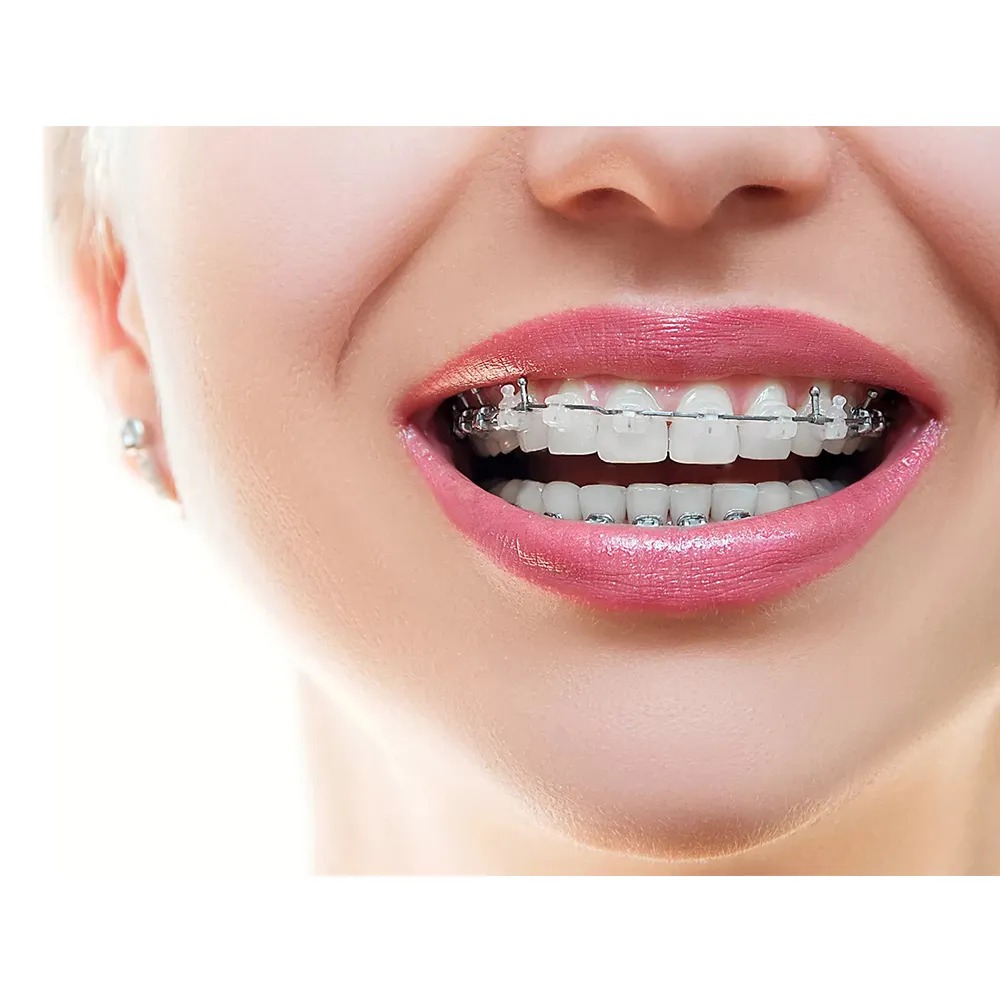 OSL Heat Activated NiTi Ovoid Form Archwires - Round (Pack of 10)