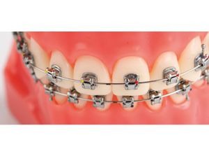 OSL Stainless Steel Ovoid Form Archwires - Round