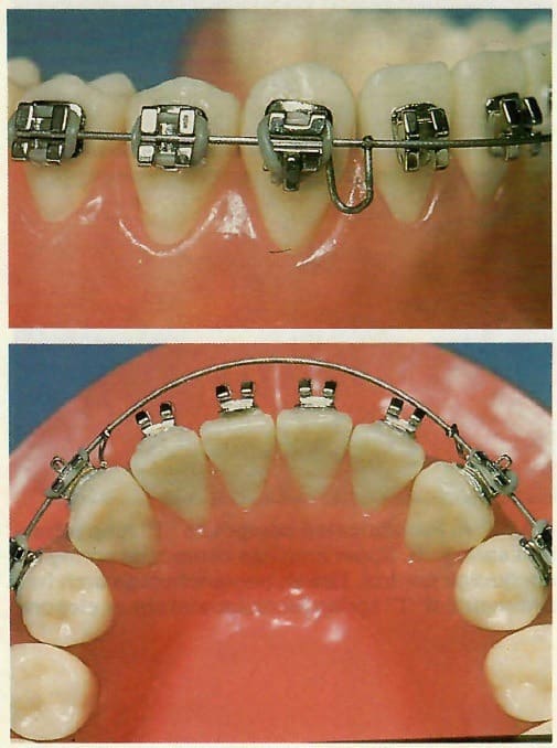 OSL Beta-Titanium Ovoid Form Archwires - Rectangular