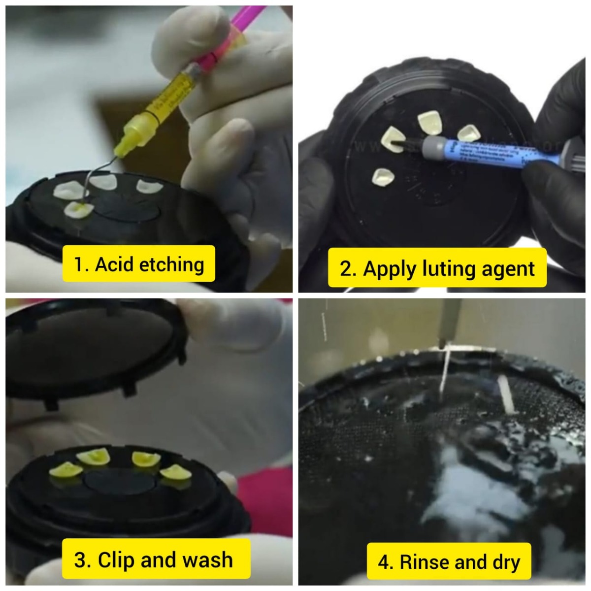 HN Dental Youni Smart Veener Box