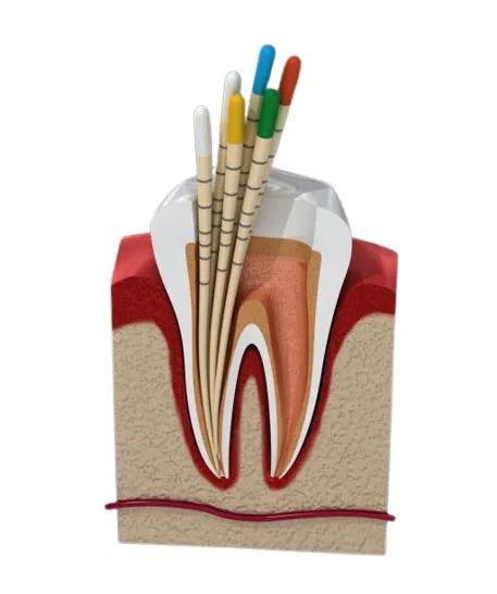 Waldent Gutta Percha Points 4% (Length Marked)