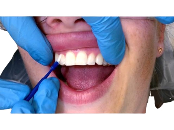 ICPA Fluoritop SR Neo Dental Varnish