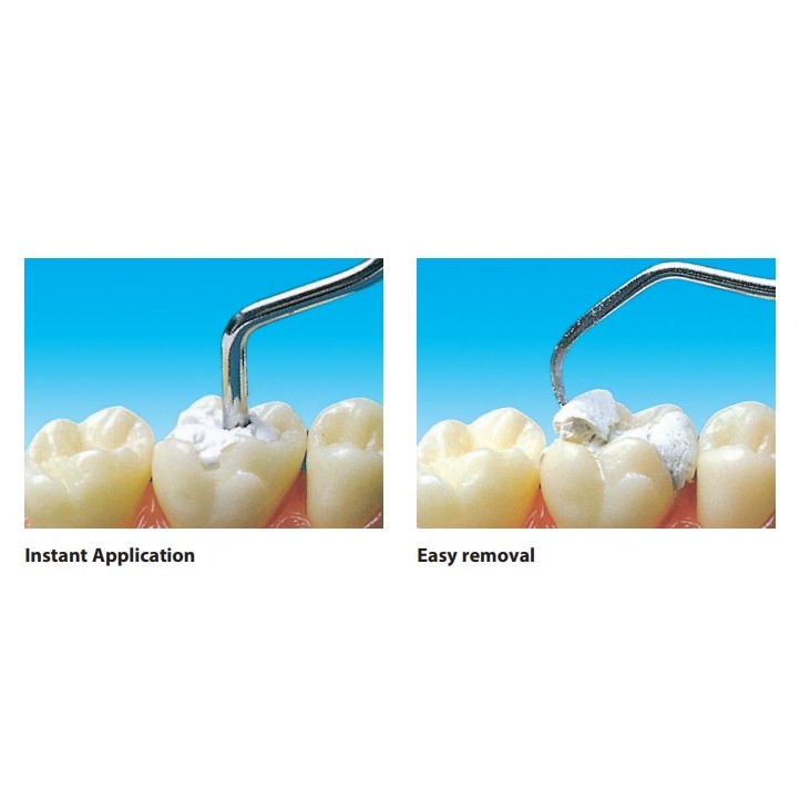 Coltene Coltosol F Temporary Filling Material 