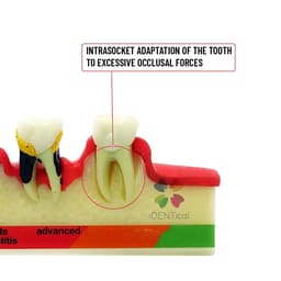 iDENTical Stages Of Periodontitis Model - M4010 - 4