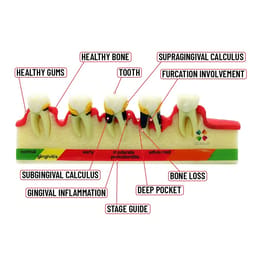 iDENTical Stages Of Periodontitis Model - M4010 - 5