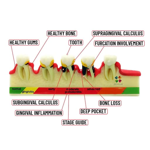 iDENTical Stages Of Periodontitis Model - M4010