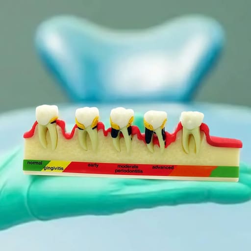 iDENTical Stages Of Periodontitis Model - M4010