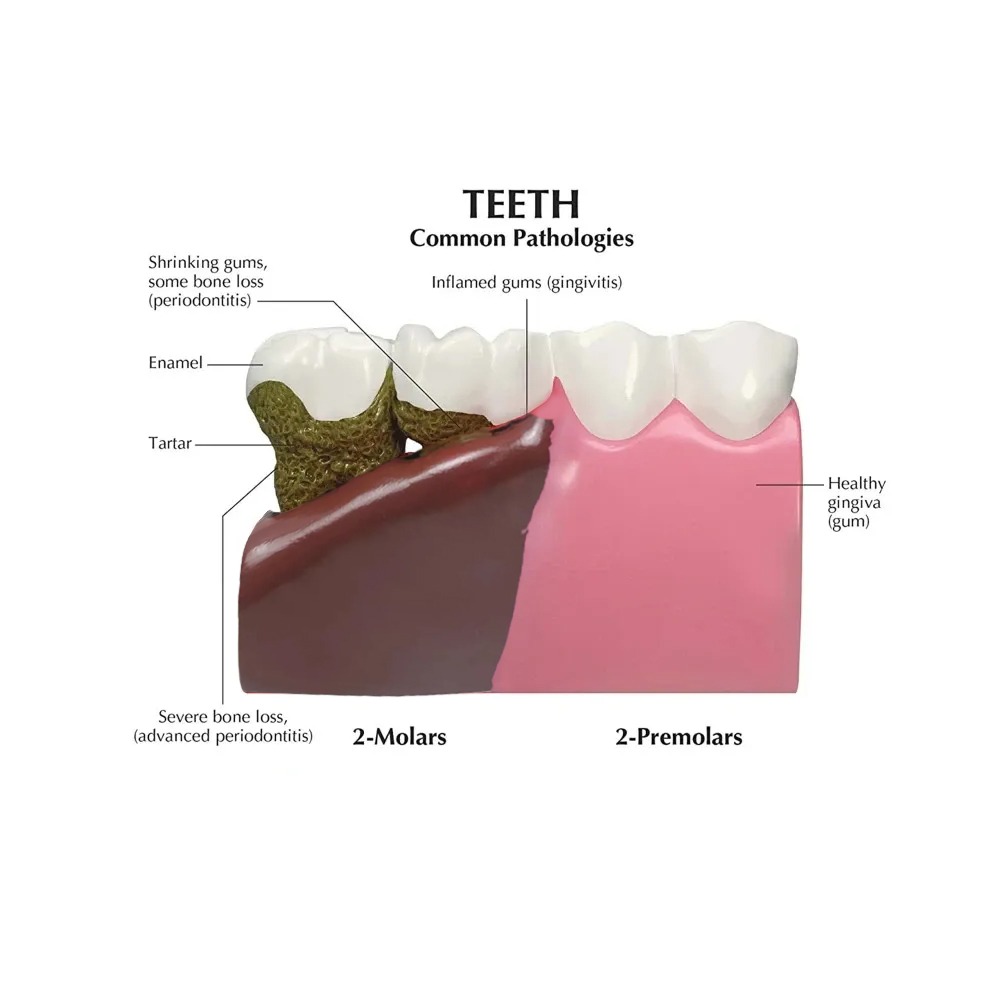 iDENTical Diseased Teeth and Gums Model M4029
