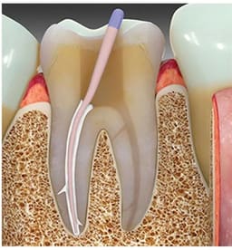 Maarc Rootfyx (9107/1X4) - 5