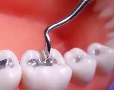 Dpi Dental Amalgam Alloy-Non-Gamma 2
