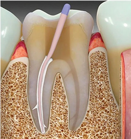 Maarc CeraSeal-B Sealer (8501/001)