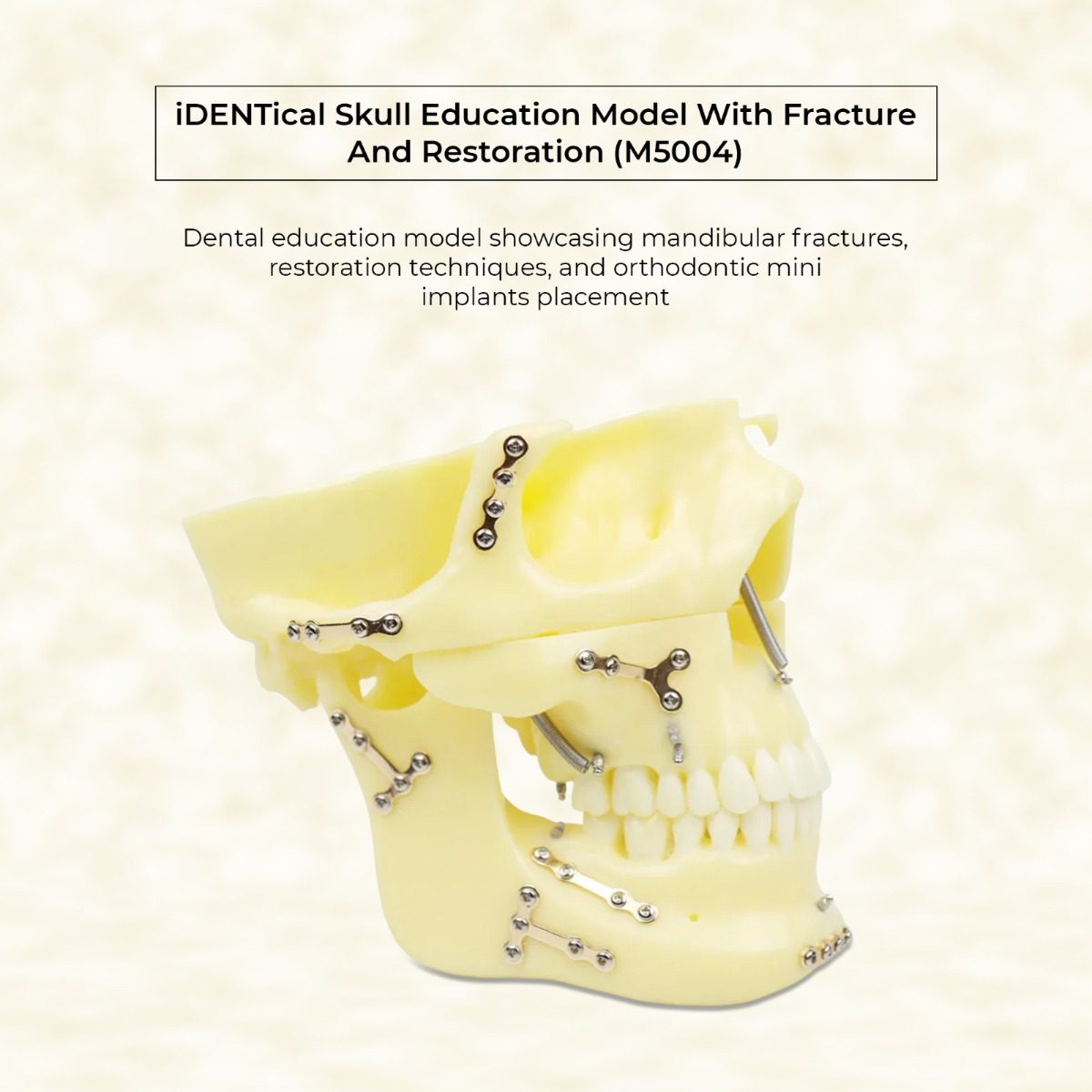 iDENTical Skull Education Model With Fracture And Restoration (M5004)