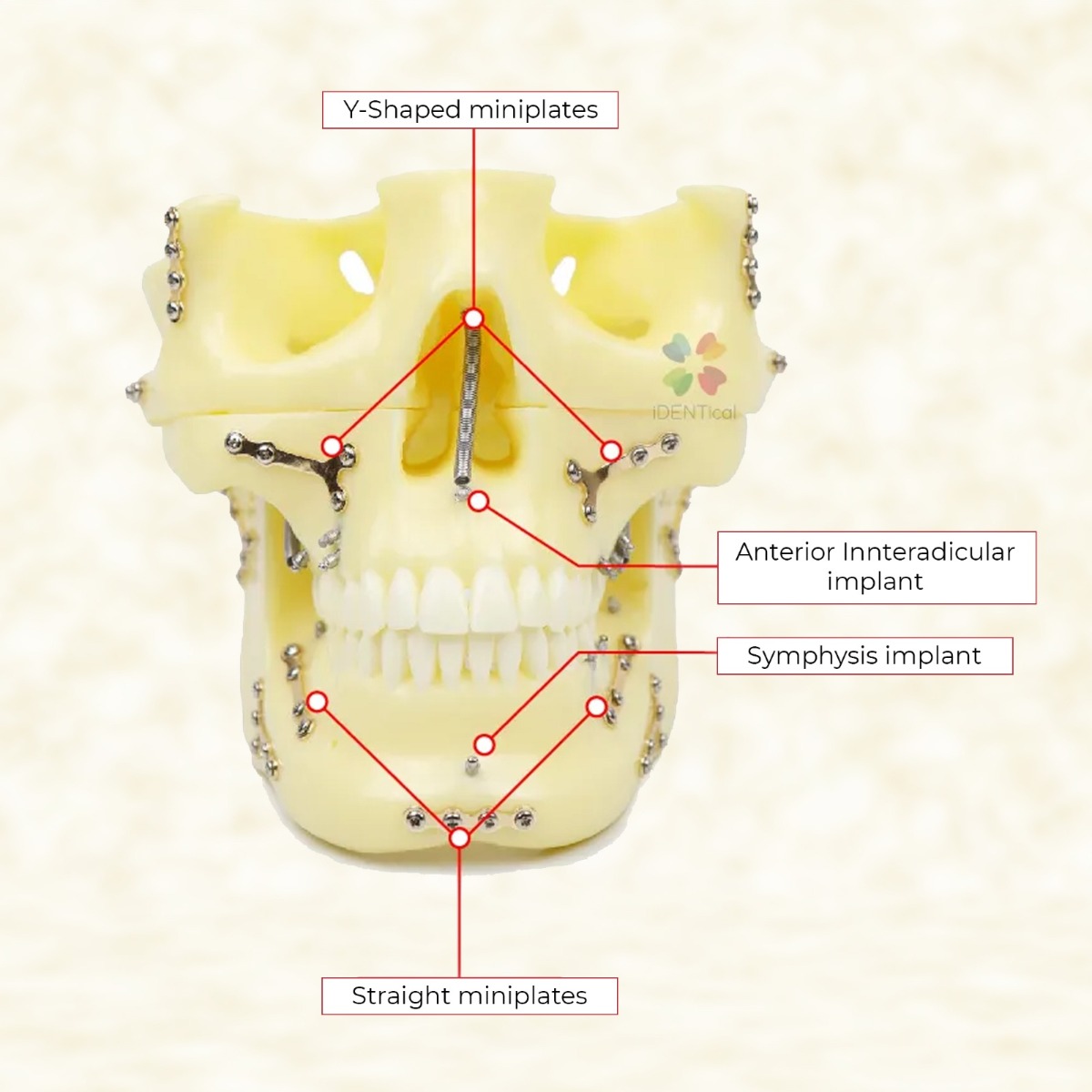 iDENTical Skull Education Model With Fracture And Restoration (M5004)