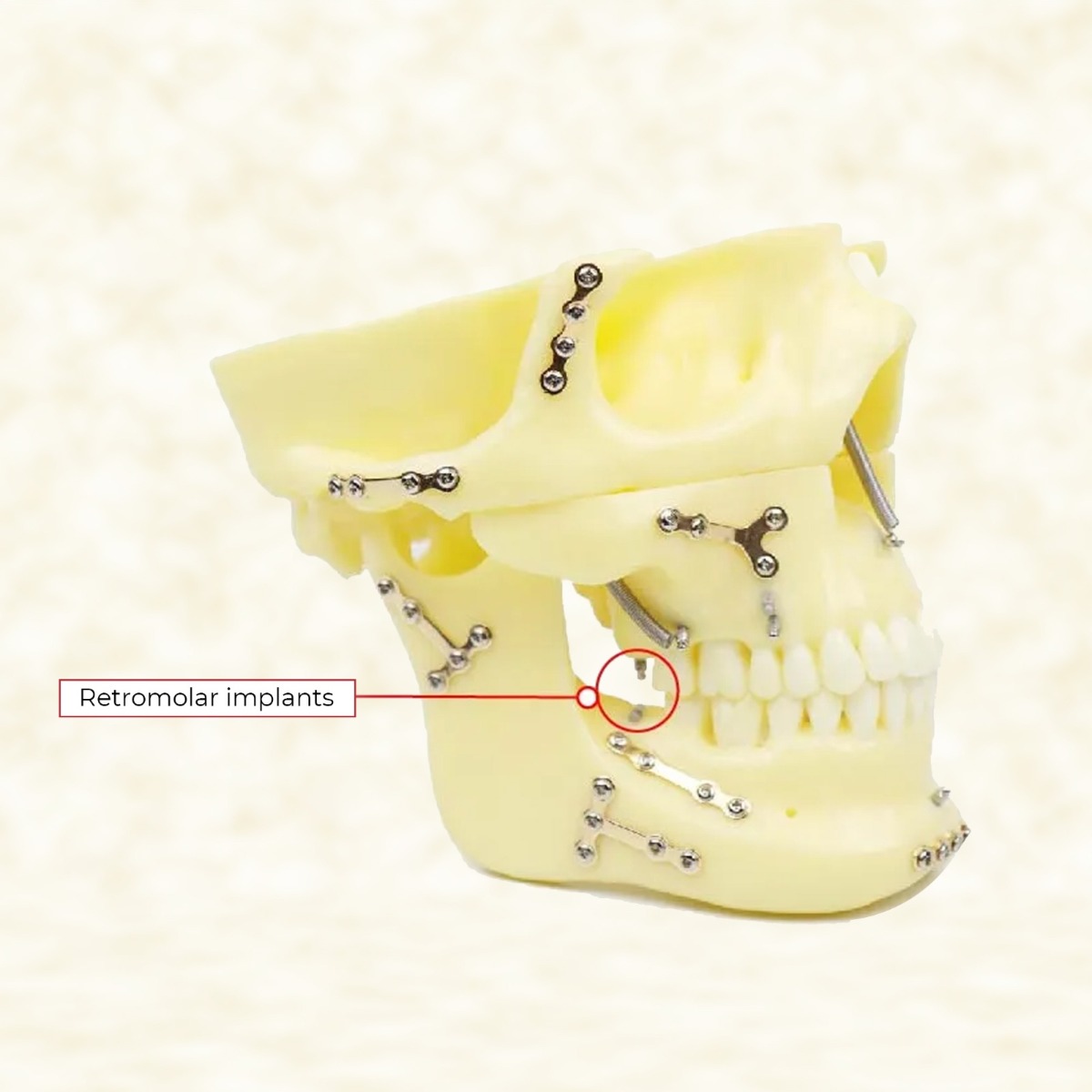 iDENTical Skull Education Model With Fracture And Restoration (M5004)