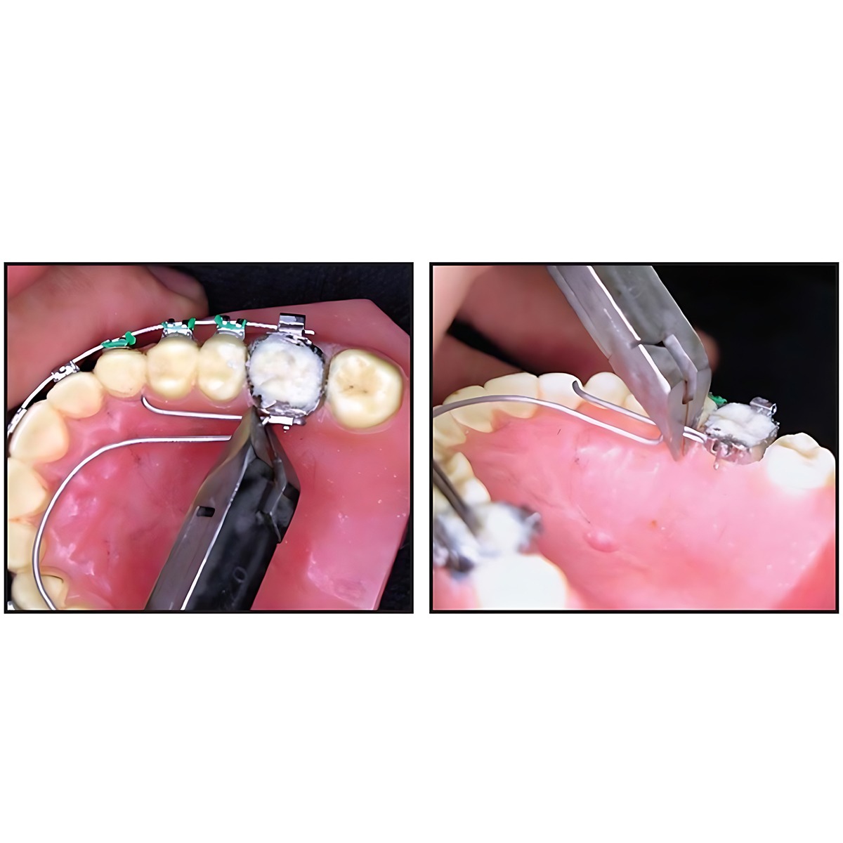 OSL Bondable Lingual Sheaths (Pack Of 10)