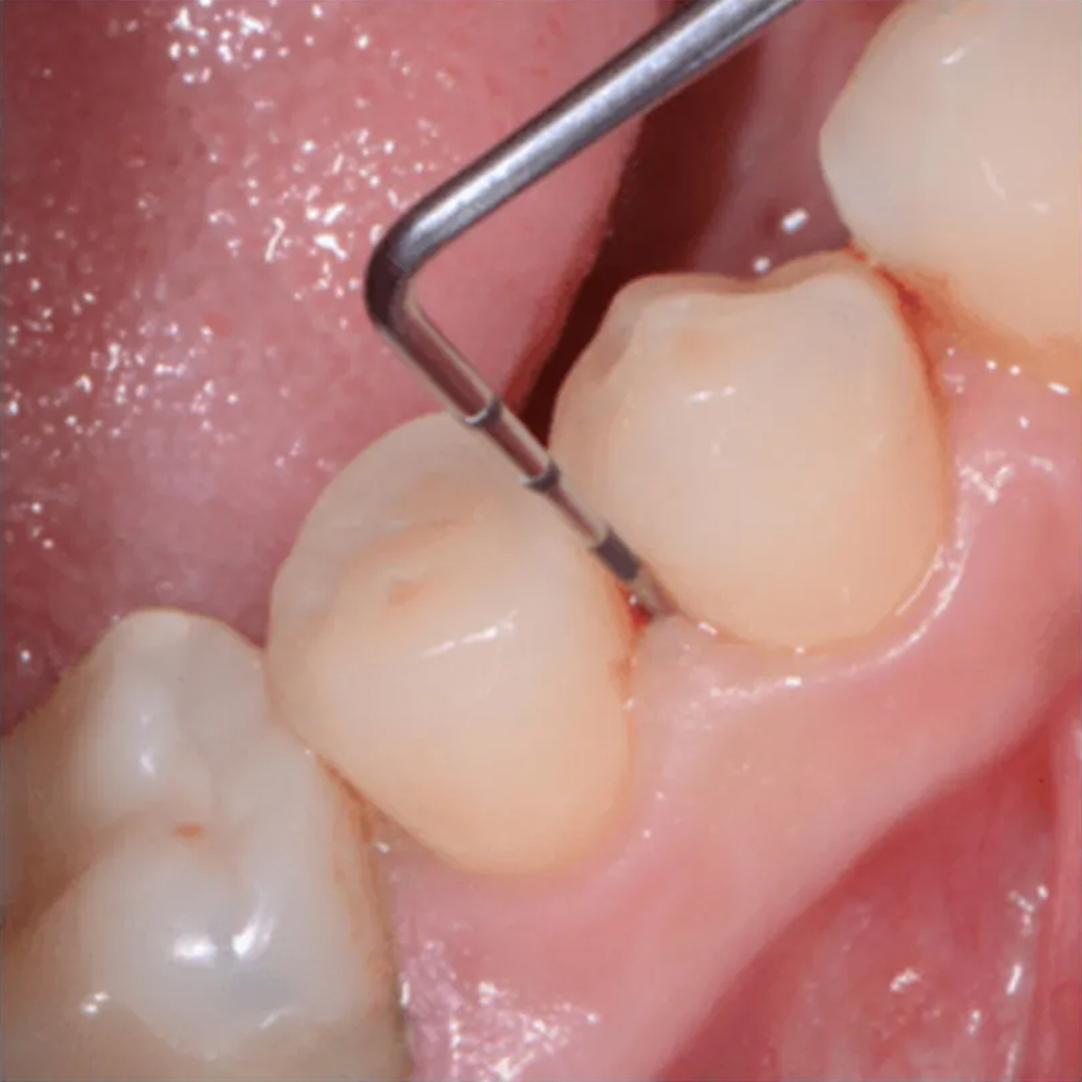 Hahnenkratt WHO Probe Ref 5010