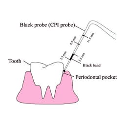 Waldent UNC 15 Probes - 5