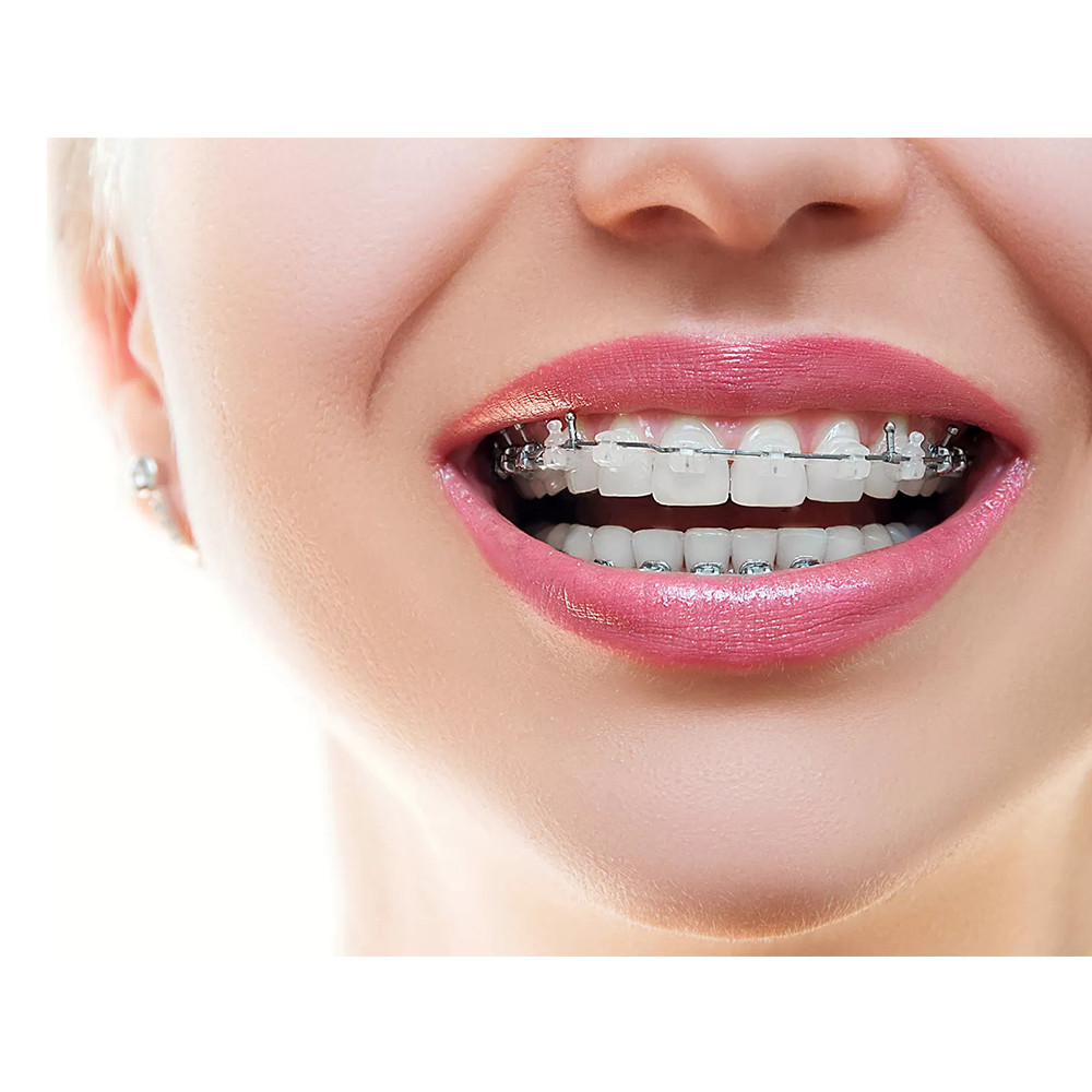 Phyx CuNiTi Preformed Archwire (Pk of 2)