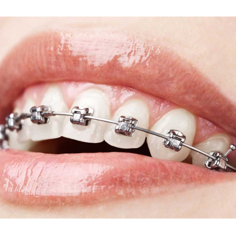 Fox Solo Niti Preformed Wire Ovoidform Pack Of 10Pcs