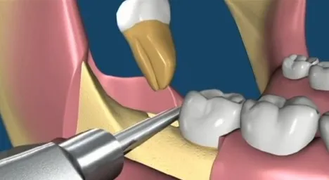 GDC Root Elevator Set Of 9 In Pouch (RESP9)