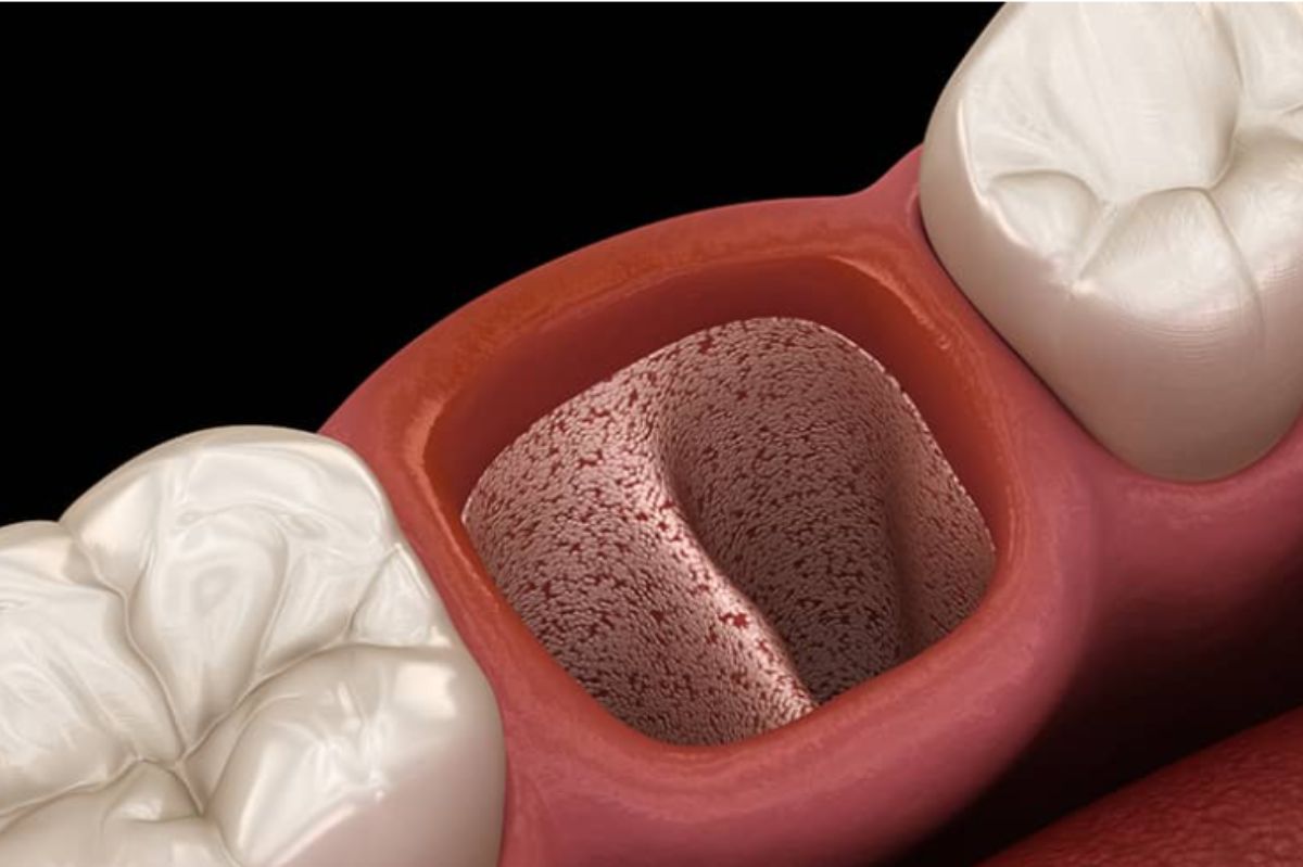 Vishal Dentocare A.O. Gel Dry Socket Paste