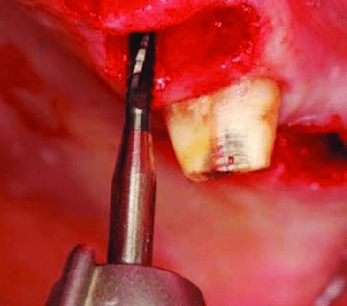 Prima Dental Oral Surgery Toller Taper Fissure Bur 702 HP