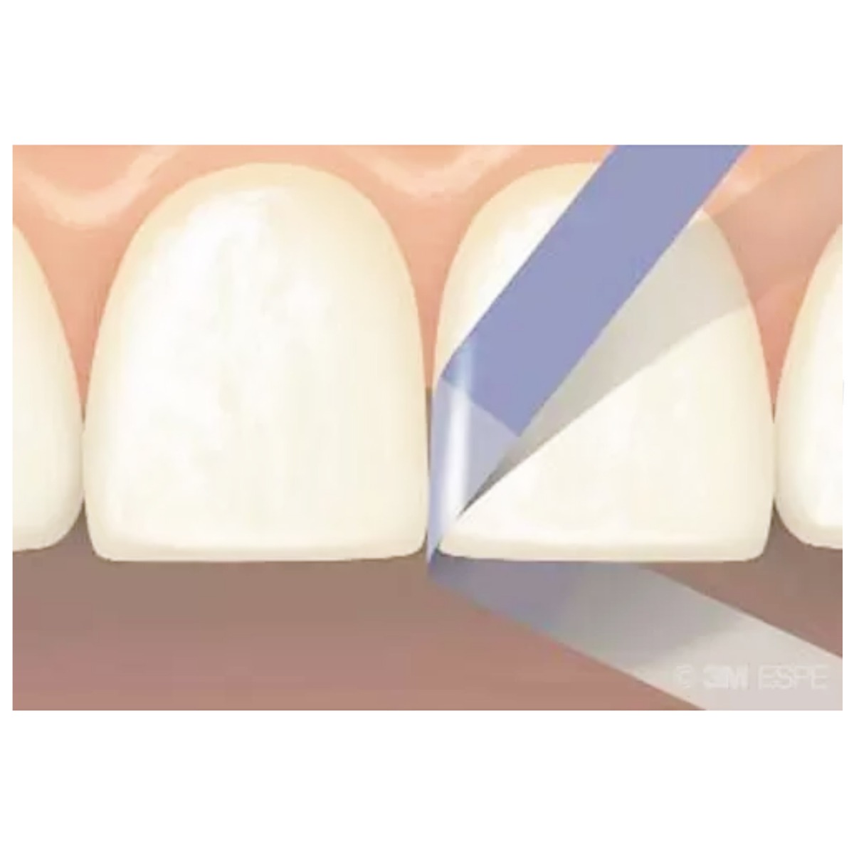 3M ESPE Sof-Lex Finishing Strips - Refills