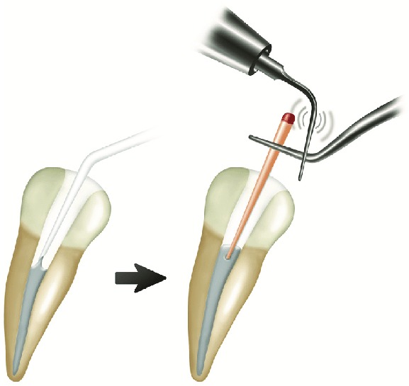 GDC G.P. Holding Tweezer - Premium (Epl1)