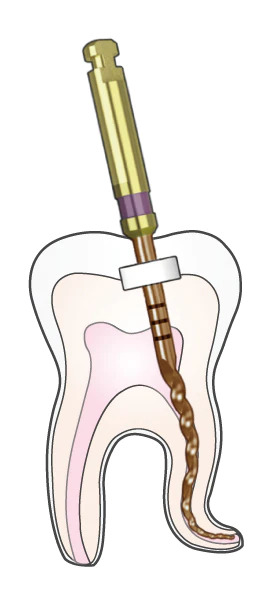 Woodpecker Endo Plus Heat Treated Gold Rotary Files