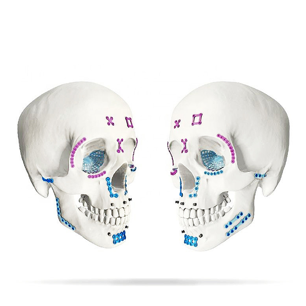 SK Surgicals Titanium Mini Bone Plates Orbital Continuous - 2mm