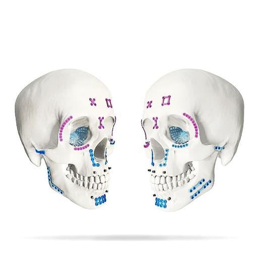 SK Surgicals Titanium Mini Bone Plates Orbital Continuous - 2mm