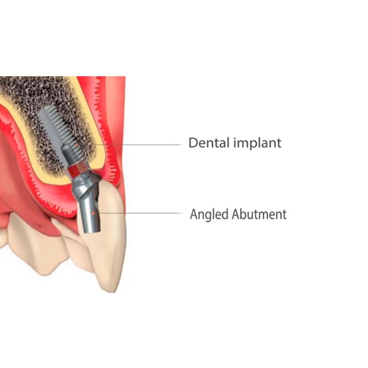 Xcem Dental Implant Angled Abutment Mini 4.5mm - Non Hex