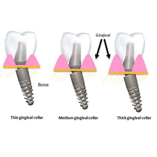 Xcem Dental Implant Angled Abutment Type A 4.5mm - Hex 
