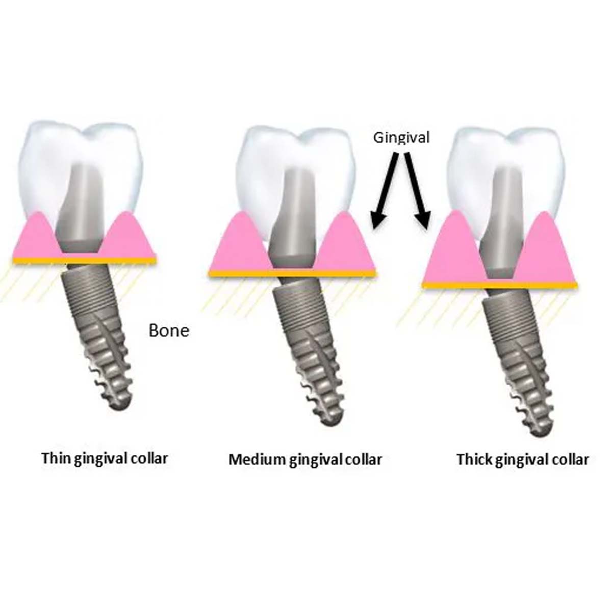 Xcem Dental Implant Angled Abutment Type B Mini 4.5mm - Hex 