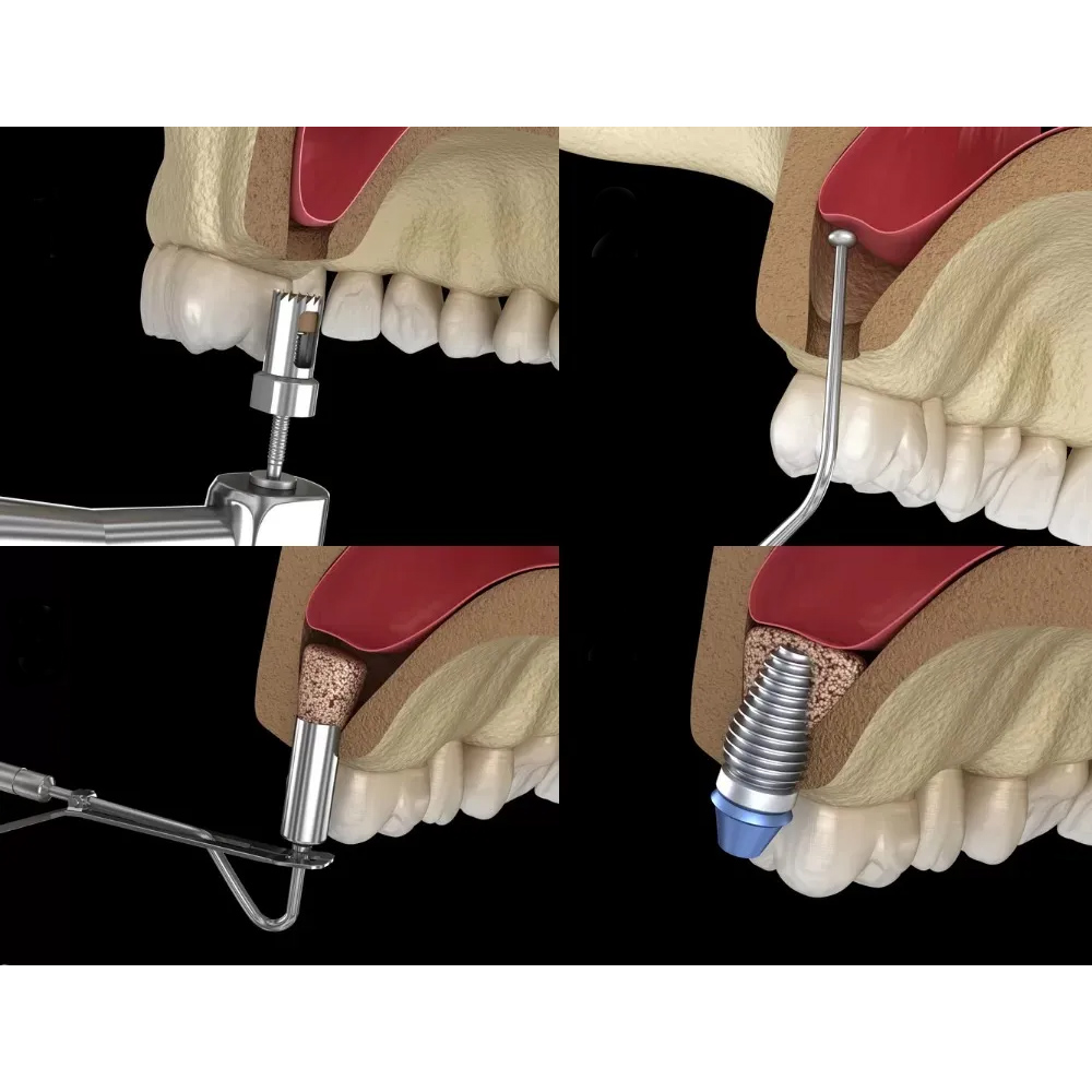 Xcem Osspore Bone Grafts For Sinus And Implantitis Repair
