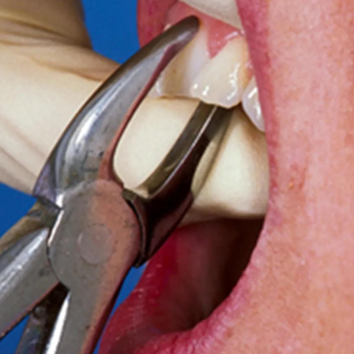 Oracraft Upper Anterior Extraction Forceps - Premium (FX1P)