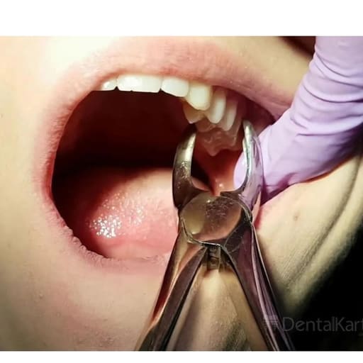 Oracraft Extraction Forceps Premium