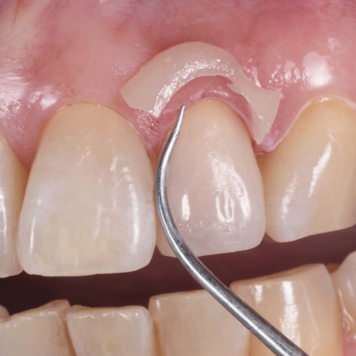 Ammdent URC Dual Cure Resin Cement