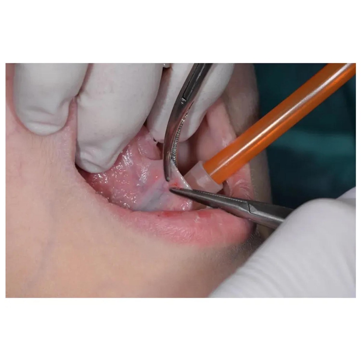 Oracraft Hemostat Kelly - Curved (H2)