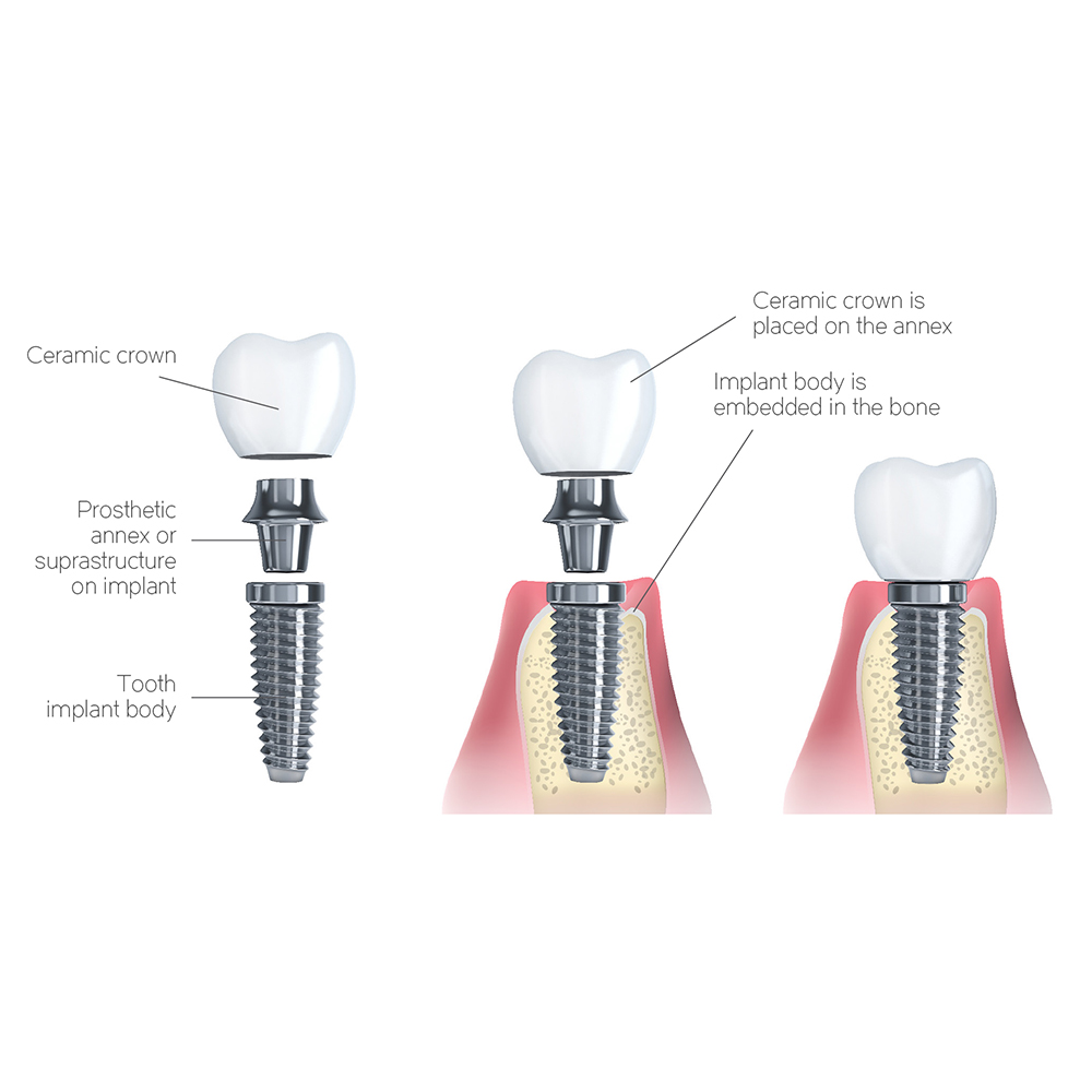 Xcem XE Submerged Dental Implant 5mm