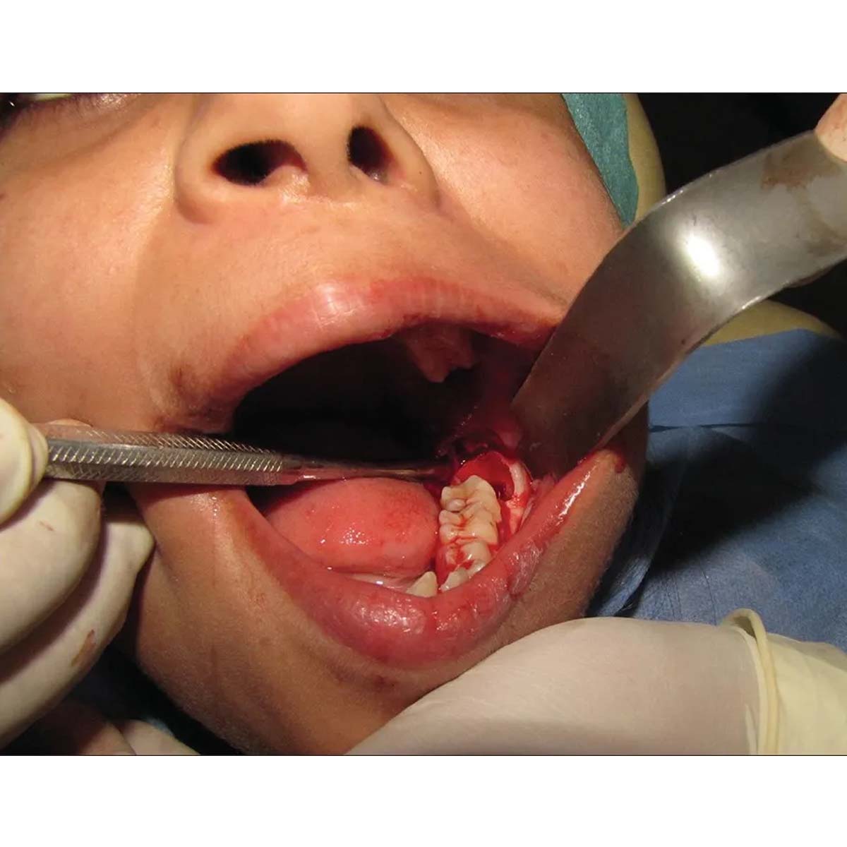 Oracraft Austin Cheek Retractor