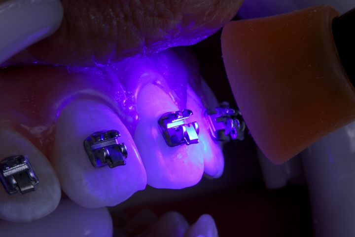 Ormco Enlight Light Cure Adhesive 1 Syringe 4 Gms + Bond 5ml (Kit) Combo