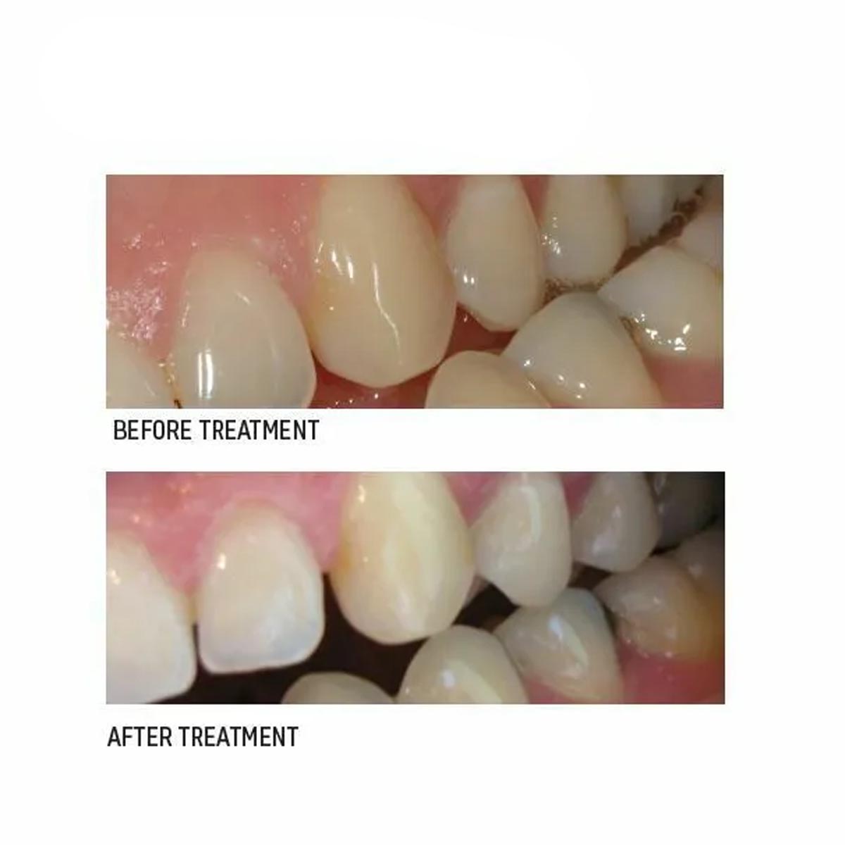 SDI Riva Star Aqua Tooth Desensitizer Bottle Kit