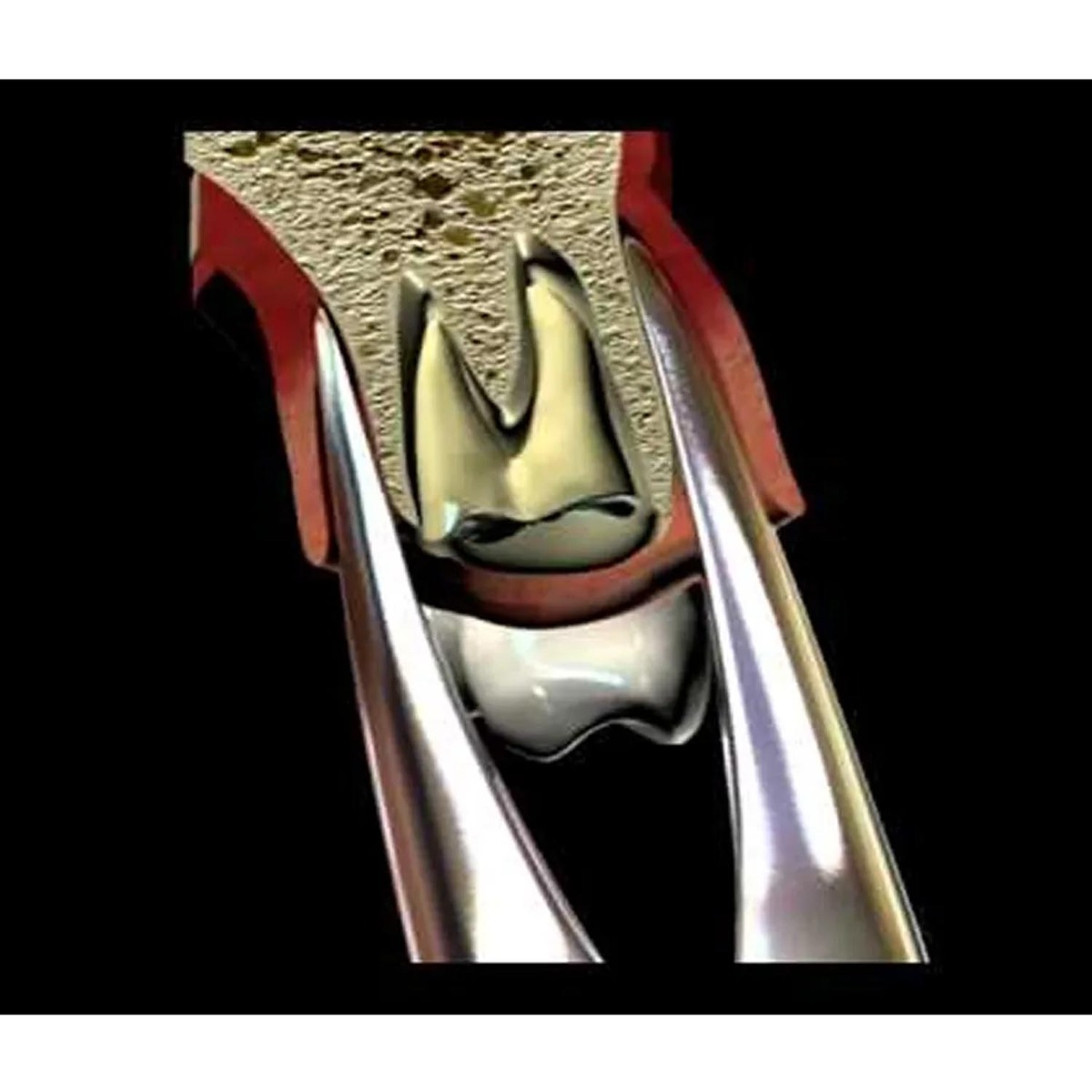 Oracraft  Extraction Forceps Premium